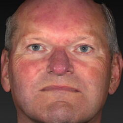 rosacea