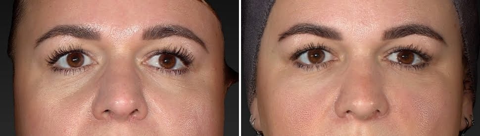 tearthrough behandeling voor en na