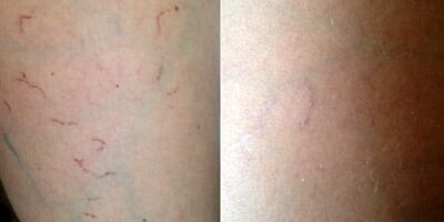behandeling spatadertjes benen