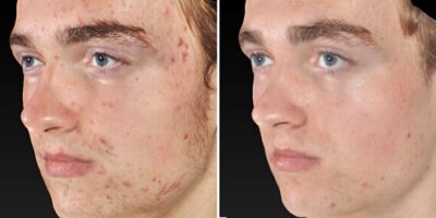 acne-behandeling-voor-na